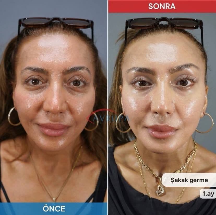 3 Badem göz estetiği