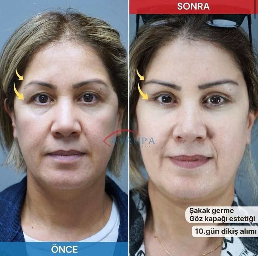 1göz kapağı estetiği 