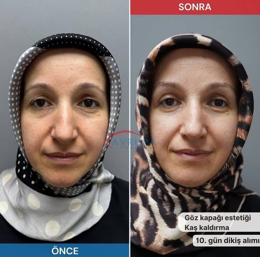 göz kapağı estetiği
