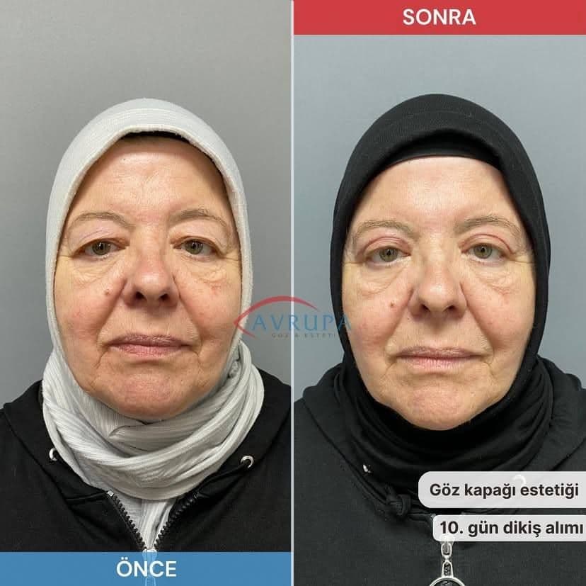 1 Göz altı torbalanma