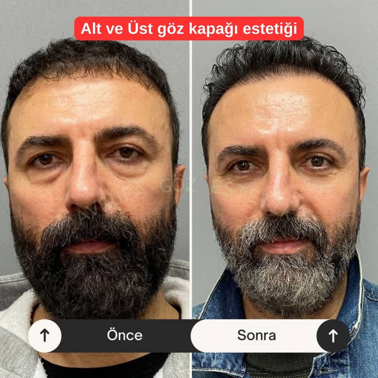 erkek göz kapağı estetiği