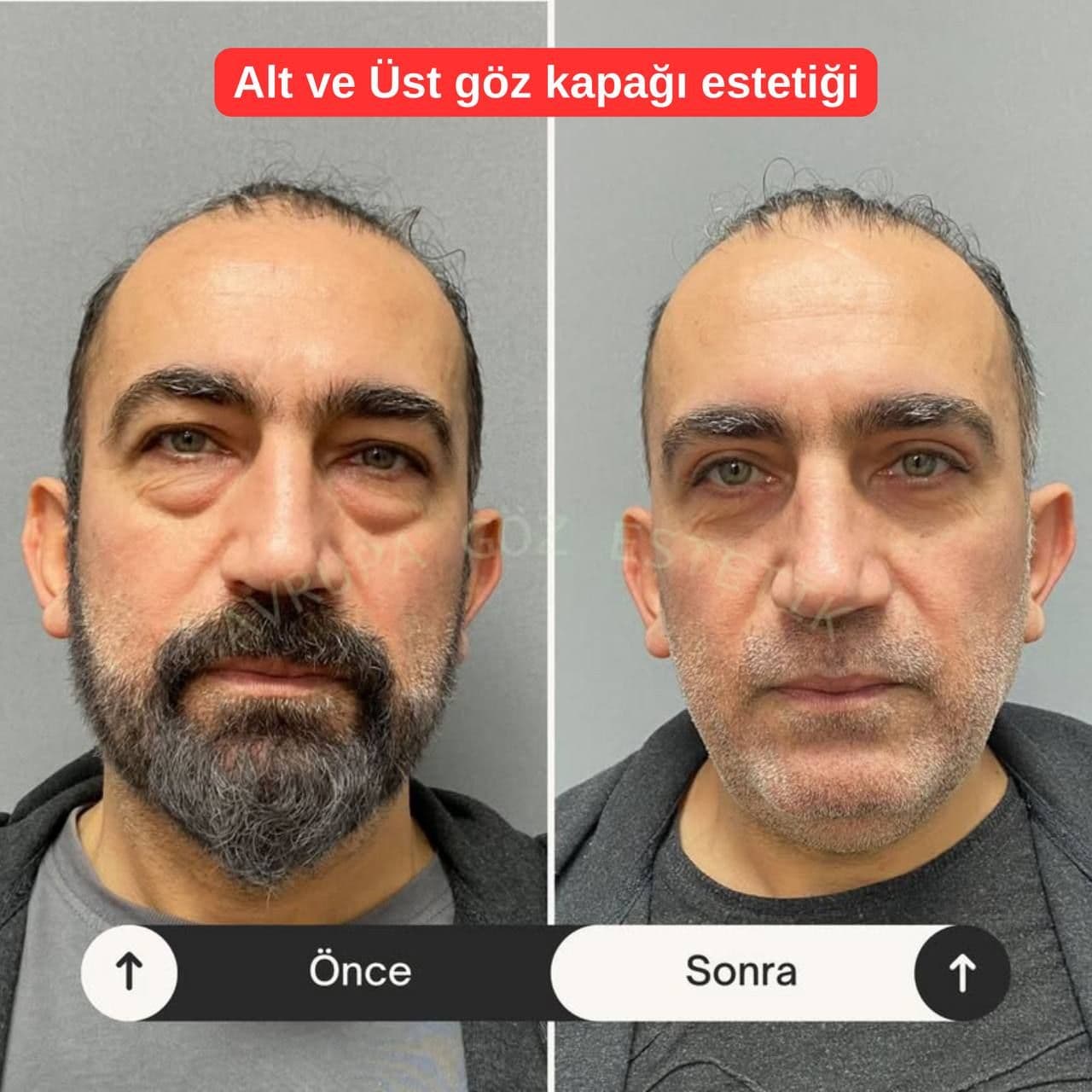 1 göz kapağı estetiği