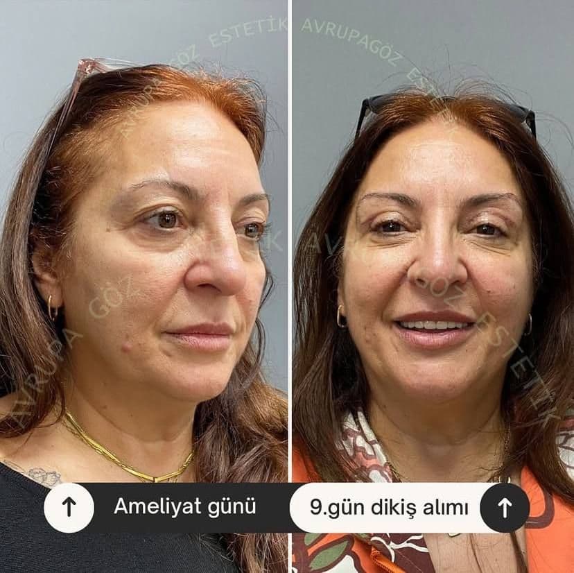 badem göz