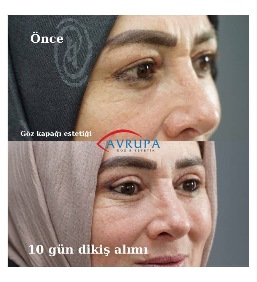 Goz kapagi estetiki