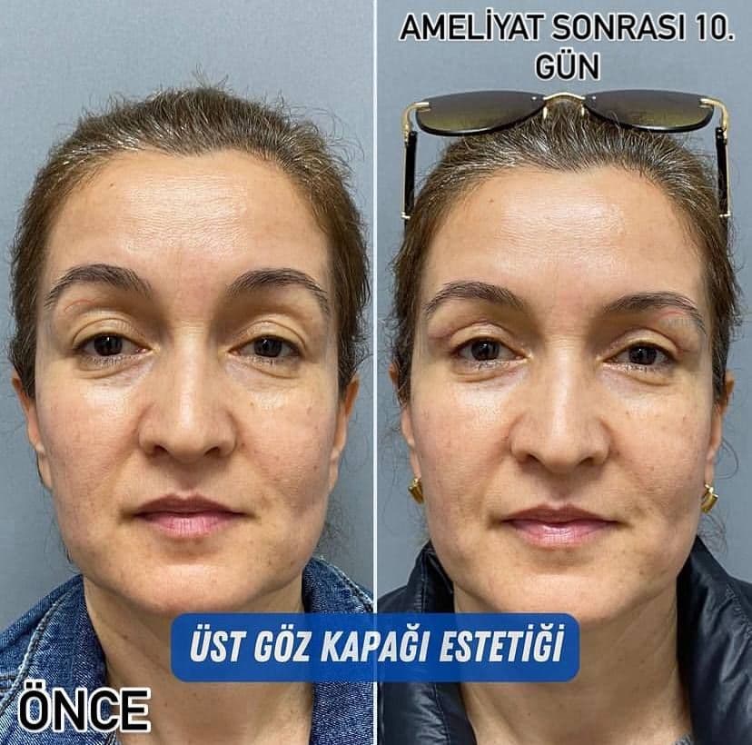 bu bir goz kapagi estetigidir