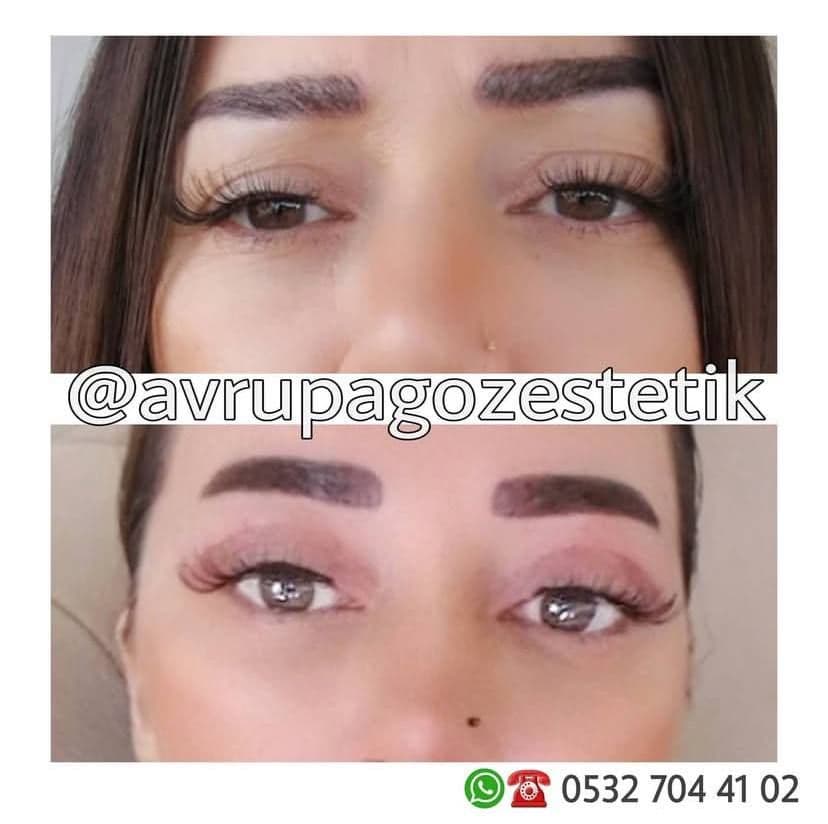 bu bir goz kapagi estetigidir