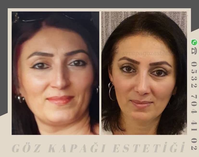 popo estetigi