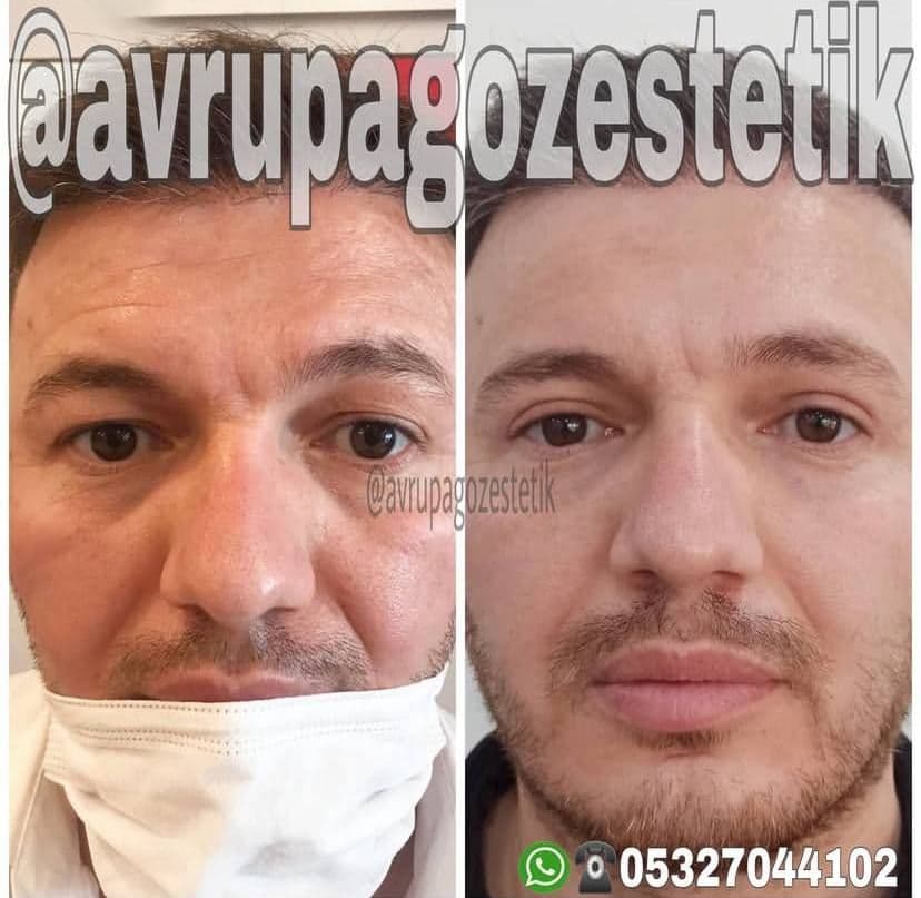 bu bir goz kapagi estetigidir