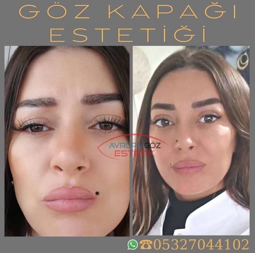 bu bir goz kapagi estetigidir
