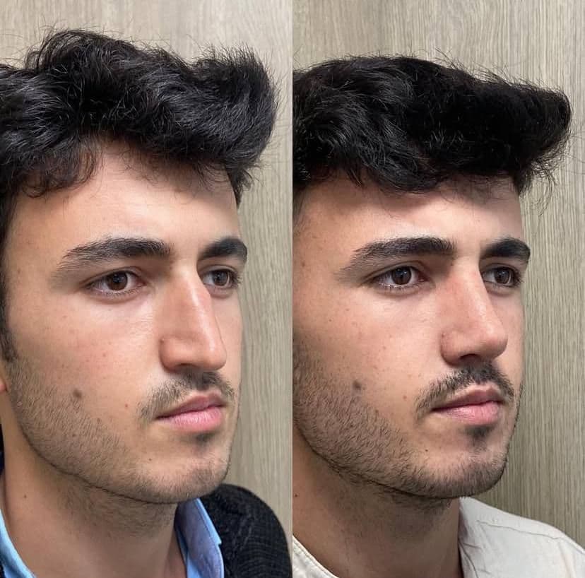 burun estetiği