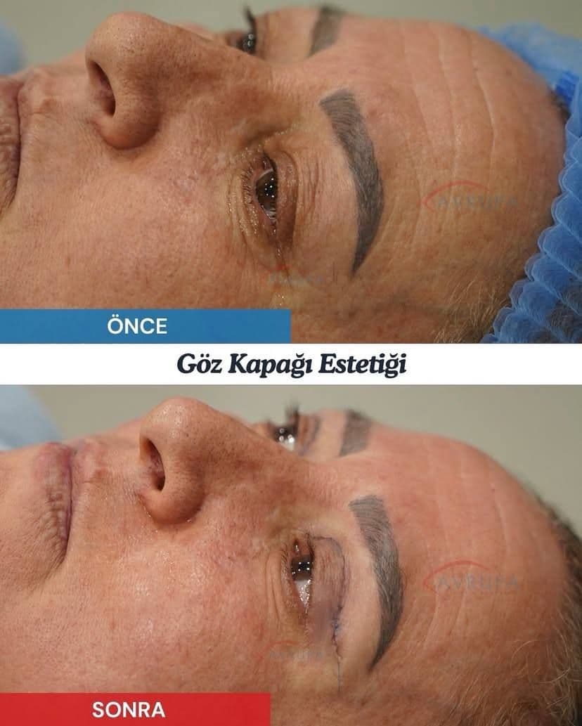 Şakak germe