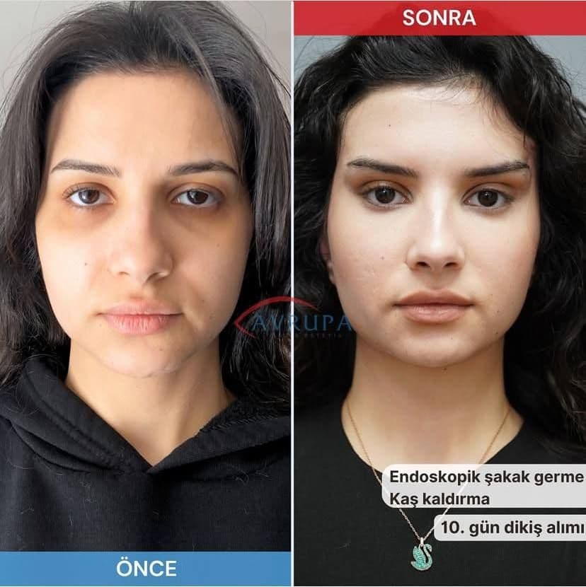 1Badem göz estetiği